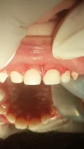 Patient 4 after treatment