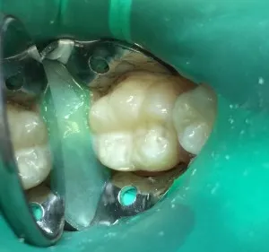Patient 6 after treatment