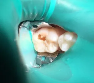 Patient 6 before treatment