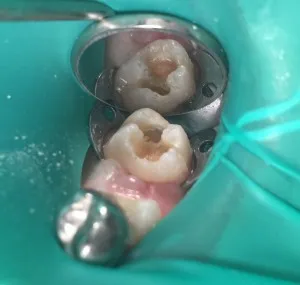 Patient 7 before treatment