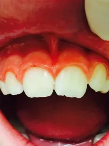 Patient 9 after treatment