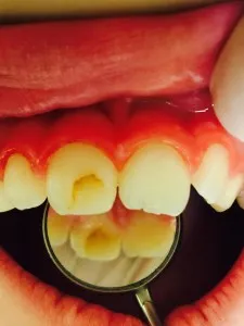 Patient 9 before treatment